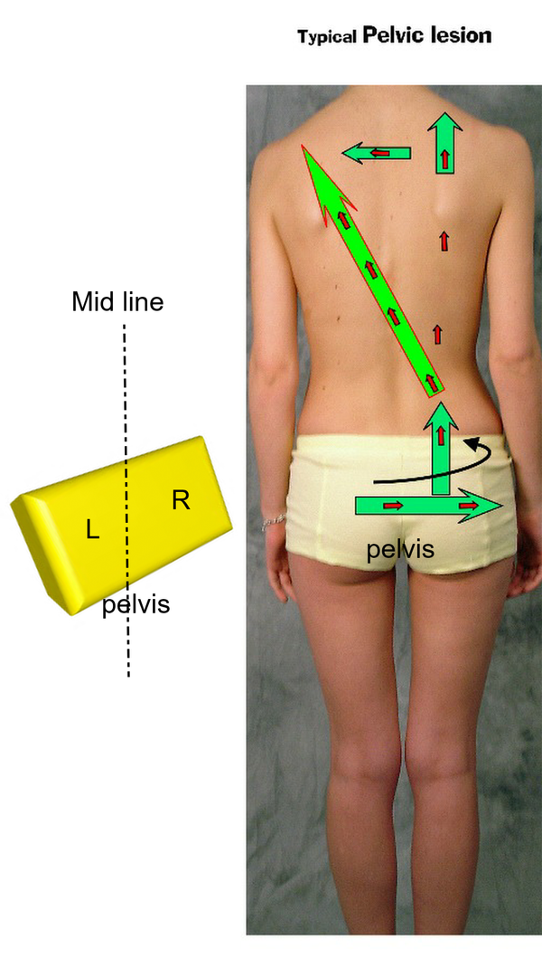 Pelvic Lesion Forces